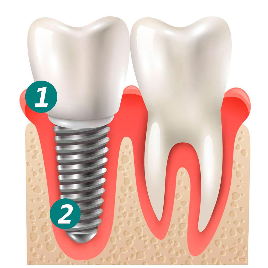 parte-implante-dental